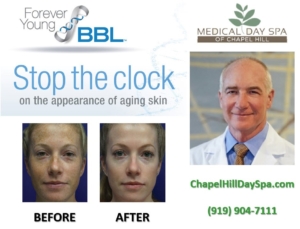BroadBand Light  BBL Photo Facial Now Available At The Medical Day Spa Of Chapel Hill In North Carolina And Is Being Launched On Presidents Day February 18, 2018